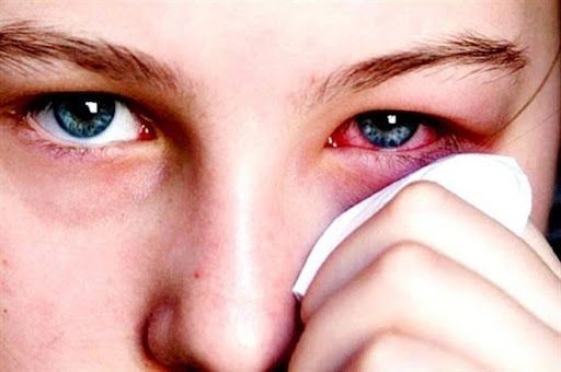 Tuyên truyền bệnh đau mắt đỏ